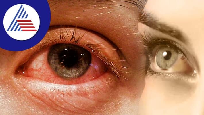 Madras Eye infection found in Udupi gow Madras Eye infection found in Udupi gow