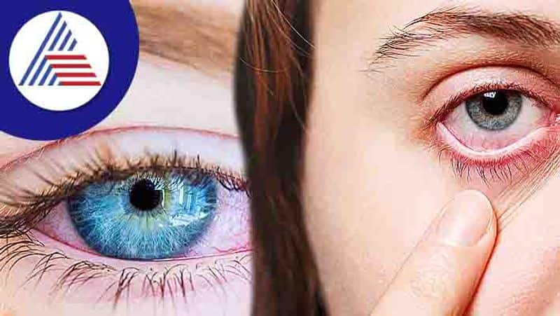 Conjunctivitis: What is Pink Eye? What are symptoms, causes and treatment? Stay safe RBA