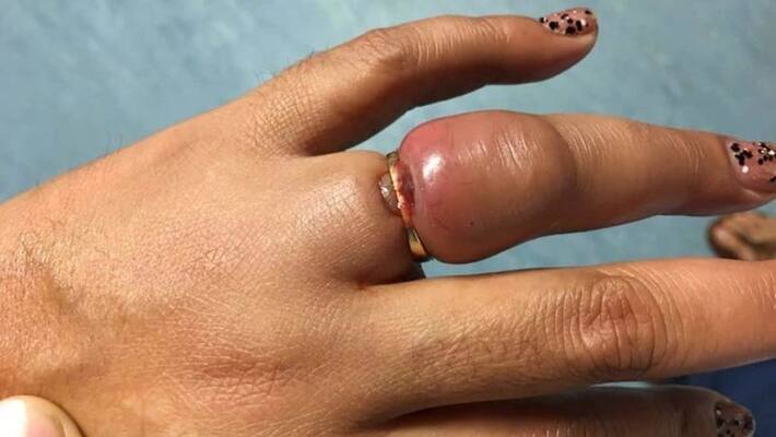 Woman gets rings stuck on her finger removed Woman gets rings stuck on her finger removed