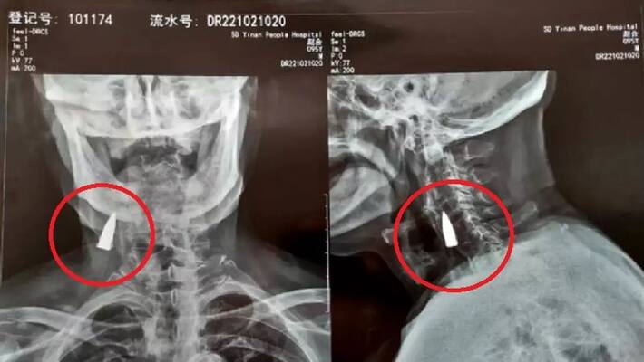 xray revealed a bullet lodged in mans neck for nearly eighty years at china xray revealed a bullet lodged in mans neck for nearly eighty years at china