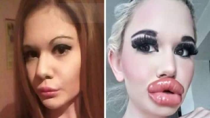 woman with world's biggest lips now wants this woman with world's biggest lips now wants this