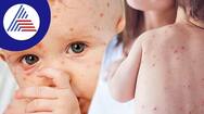 Measles Outbreak In Mumbai: Protect Your Kids From This Viral Infection Vin