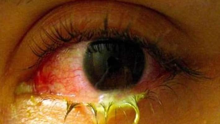 Madras Eye cases increase in Tamil Nadu Madurai Madras Eye cases increase in Tamil Nadu Madurai