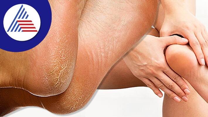 Health Tips: Home remedies for Cracked Heels during Winter Health Tips: Home remedies for Cracked Heels during Winter