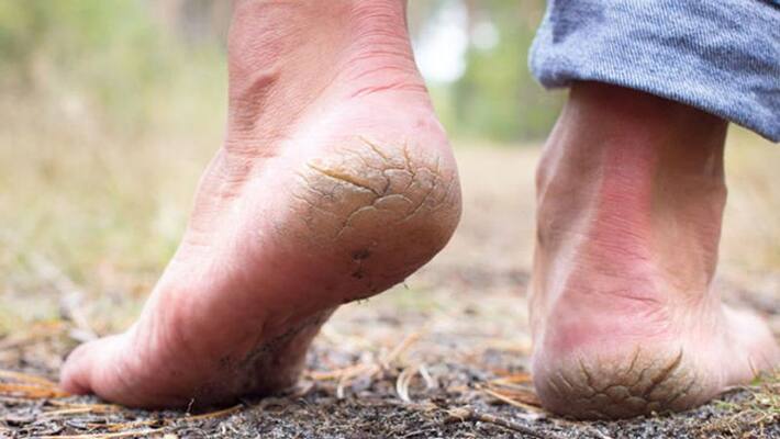 how to get rid of cracked heels, here are some tips dva