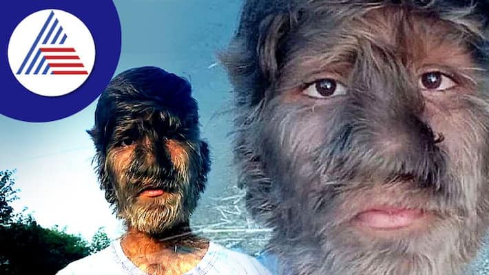 Boy With Rare Werewolf Syndrome Has Hair Growing All Over Body Vin Boy With Rare Werewolf Syndrome Has Hair Growing All Over Body Vin