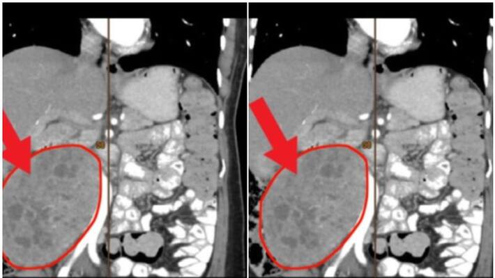 two kilo tumour removed from 55year old womans abdomen two kilo tumour removed from 55year old womans abdomen