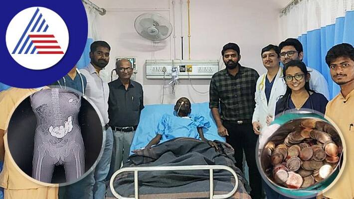 The doctor removed 187 coins from the old mans stomach at bagalkote rav The doctor removed 187 coins from the old mans stomach at bagalkote rav