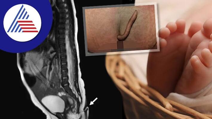 Baby Girl Born With 2 Inch Long True Tail, Images Go Viral Vin Baby Girl Born With 2 Inch Long True Tail, Images Go Viral Vin