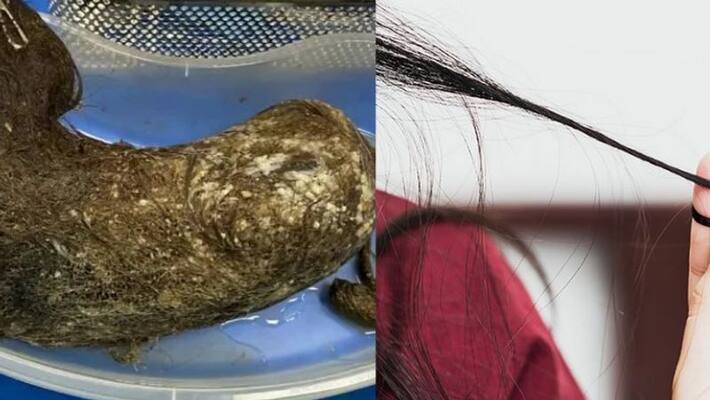 chinese girl eaten 3 kg of her hair due to mental health condition chinese girl eaten 3 kg of her hair due to mental health condition