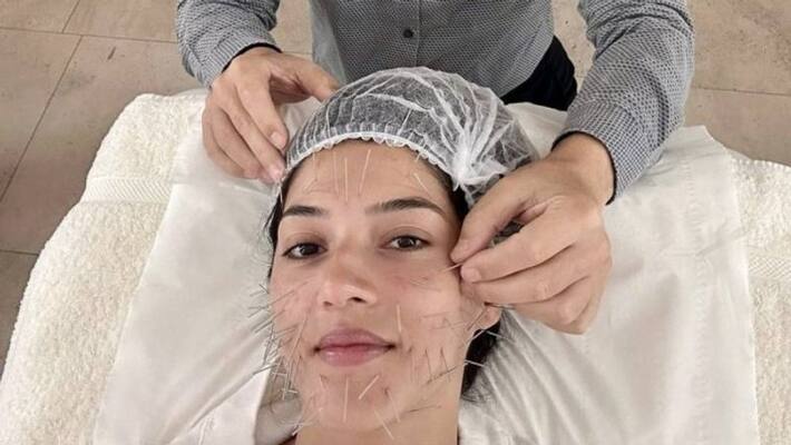 Mehreen revealed via social media that she had an acupuncture facelift Mehreen revealed via social media that she had an acupuncture facelift