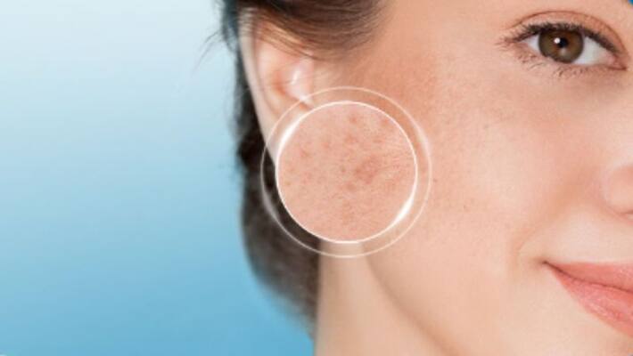 How to remove dark spots How to remove dark spots