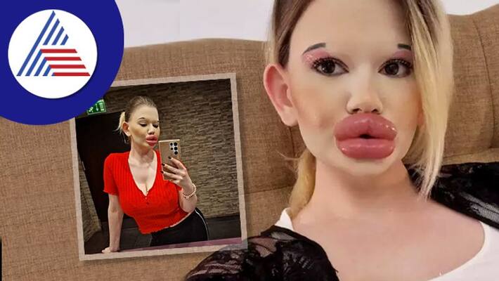 Womans Lips Are Biggest In The World, Even Breathing Through Nose Is Difficult Vin Womans Lips Are Biggest In The World, Even Breathing Through Nose Is Difficult Vin
