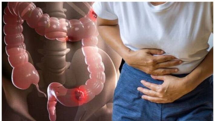 the colour in your poo that is early sign of bowel cancer the colour in your poo that is early sign of bowel cancer