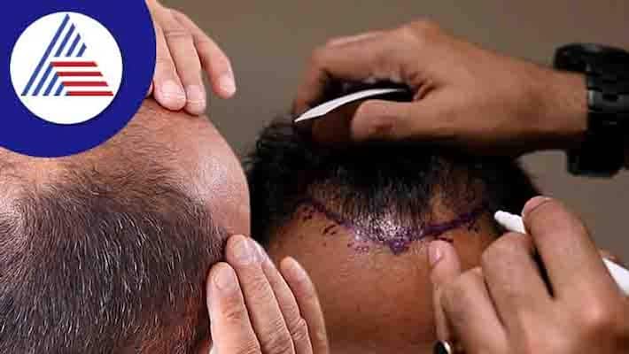 A man died after a hair transplant surgery went awry. The reason was the negligence of the doctors.. Where? A man died after a hair transplant surgery went awry. The reason was the negligence of the doctors.. Where?