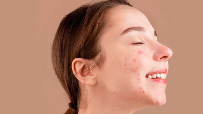 Three things you can do to reduce teenage acne Three things you can do to reduce teenage acne
