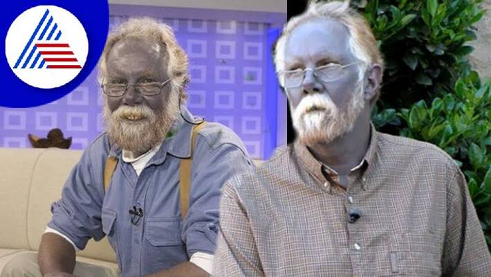 Mans Skin Turns Blue After Taking Dietary Supplements For A Decade Vin Mans Skin Turns Blue After Taking Dietary Supplements For A Decade Vin