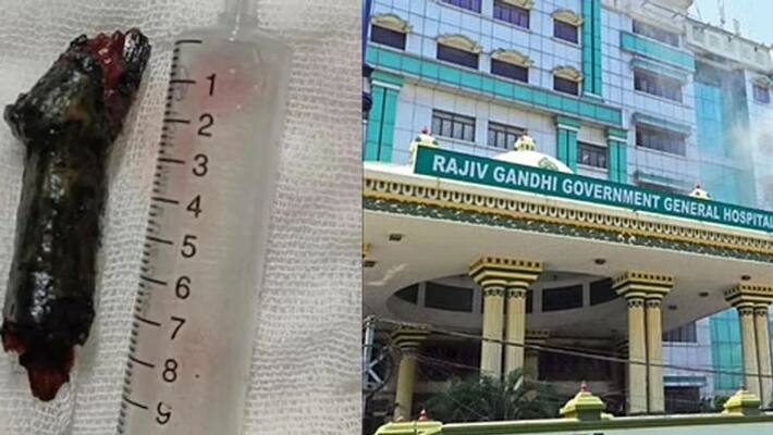 Chennai Rajiv Gandhi Government Hospital doctors remove 10-cm-long wood lodged behind man eyeball Chennai Rajiv Gandhi Government Hospital doctors remove 10-cm-long wood lodged behind man eyeball
