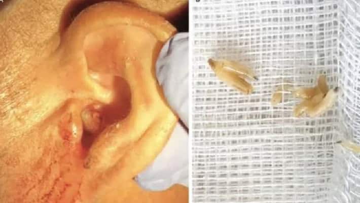 Portugal doctors found flesh eating worms on human eardrum akb Portugal doctors found flesh eating worms on human eardrum akb
