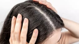 home remedies to get rid of dandruff naturally