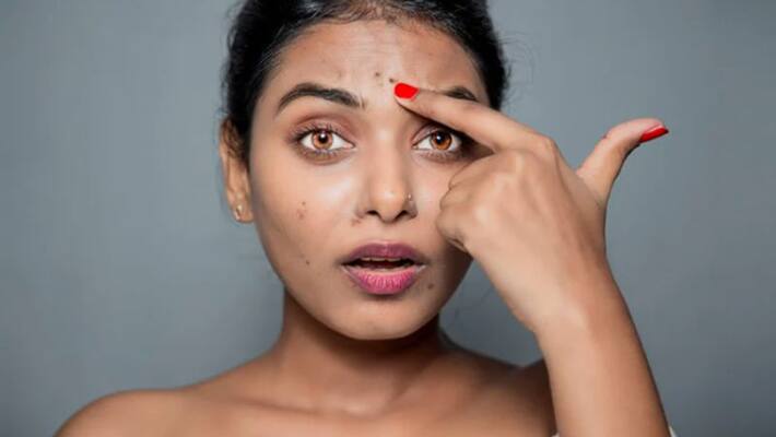 How to Get Rid of Dark Spots on the Face How to Get Rid of Dark Spots on the Face