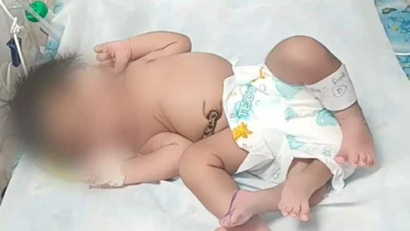 Girl Baby Born With Four Legs In Madhya Pradesh