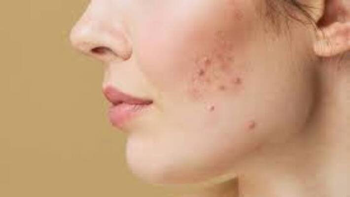 acne and hair fall may be the sign of polycystic ovary syndrome acne and hair fall may be the sign of polycystic ovary syndrome