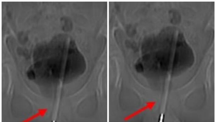 doctors remove thermometer from 12 year old boy bladder doctors remove thermometer from 12 year old boy bladder