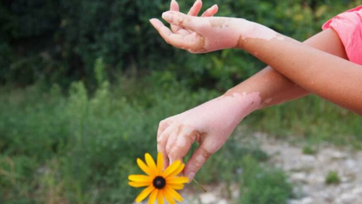 symptoms of vitiligo you should know symptoms of vitiligo you should know