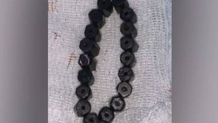 4 Year Old Complains Of Stomach Pain Doctors Find Magnetic Bracelet Inside 4 Year Old Complains Of Stomach Pain Doctors Find Magnetic Bracelet Inside