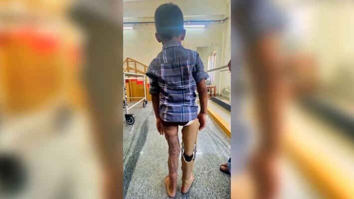 Thrissur Medical College made an artificial leg for a five year-old boy Thrissur Medical College made an artificial leg for a five year-old boy