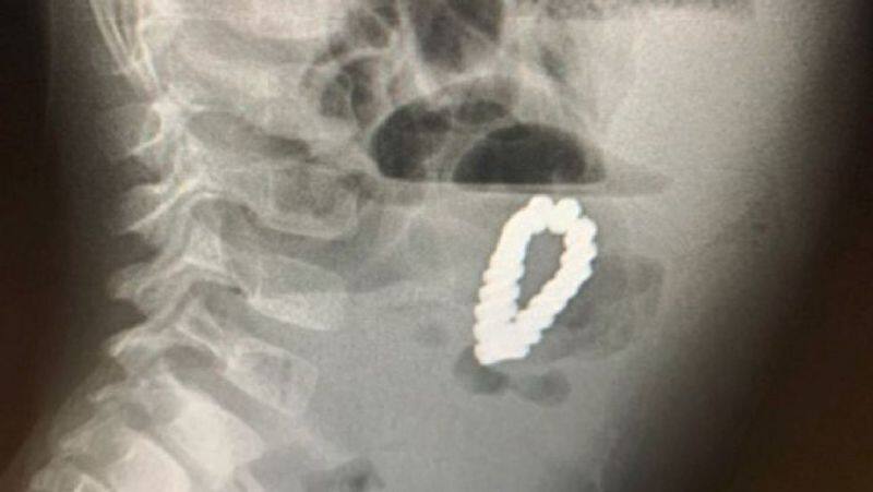 4 Year Old Complains Of Stomach Pain Doctors Find Magnetic Bracelet Inside