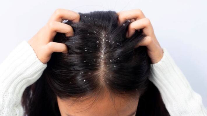 home remedies to cure dandruff home remedies to cure dandruff