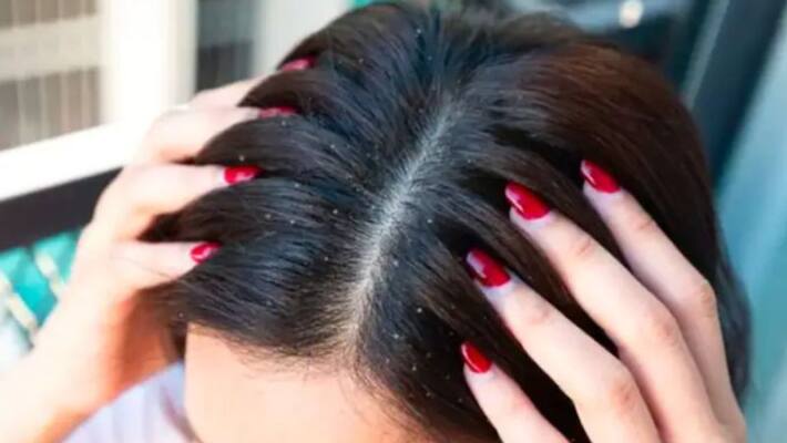 fenugreek to get rid of dandruff fenugreek to get rid of dandruff