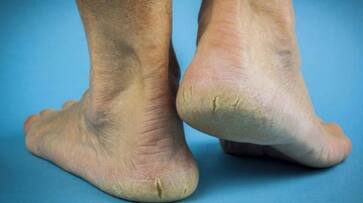 home remedies for cracked heels-rse- home remedies for cracked heels-rse-
