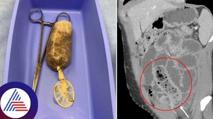 young man hospitalised for eating a banana with condom in a hormonal rage young man hospitalised for eating a banana with condom in a hormonal rage