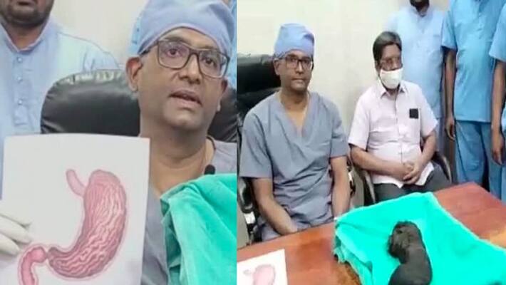 Andhra Pradesh, More than a kilo of hair lump removed from a girls stomach Vin Andhra Pradesh, More than a kilo of hair lump removed from a girls stomach Vin