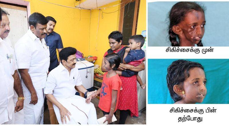 The chief minister visited the girl suffering from facial disfigurement and inquired about her well being