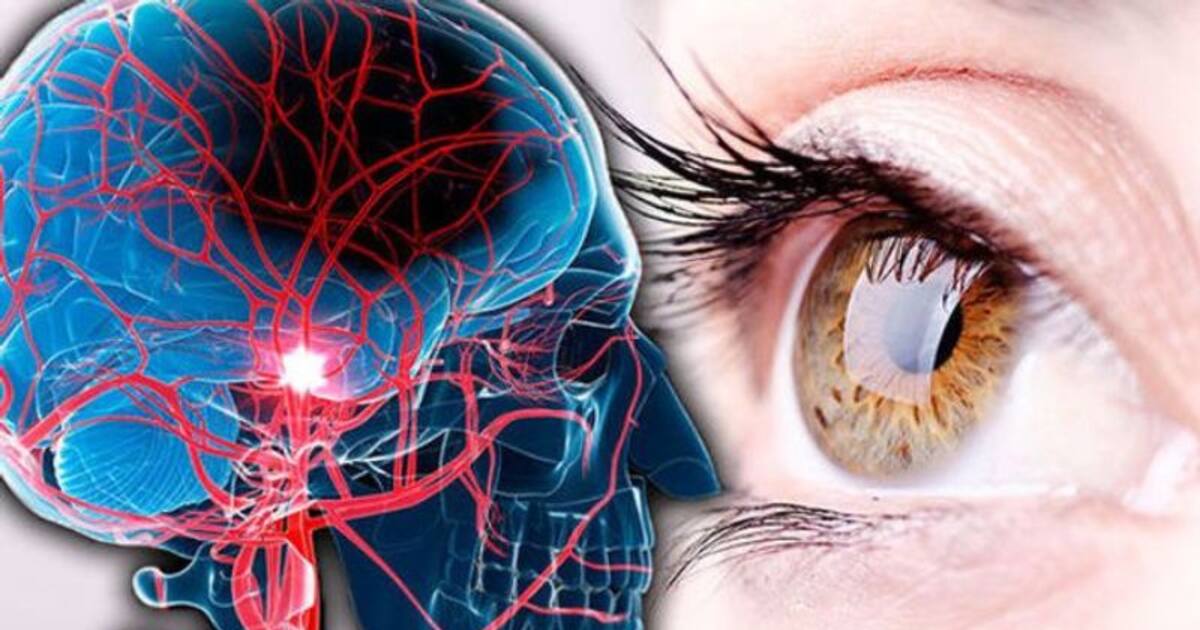 கண்ணிலும் ஸ்ட்ரோக் வரும் ஆச்சரியமாக இருக்கிறதா? இதுதான் அறிகுறிகள்!!