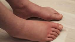 How to cure swelling in feet during pregnancy? rsl