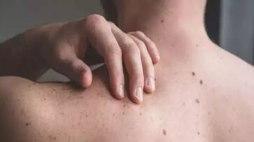 skin cancer warning signs you should never ignore-rse- skin cancer warning signs you should never ignore-rse-