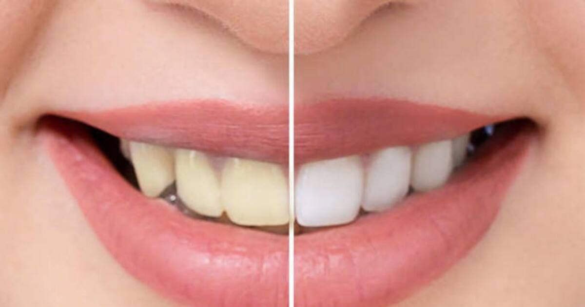 6-best-natural-way-to-remove-plaque-from-teeth-at-home-in-tamil