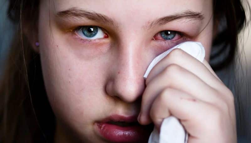 The Silent Onslaught - Pink eye (conjunctivitis) epidemic strikes during monsoon RBA