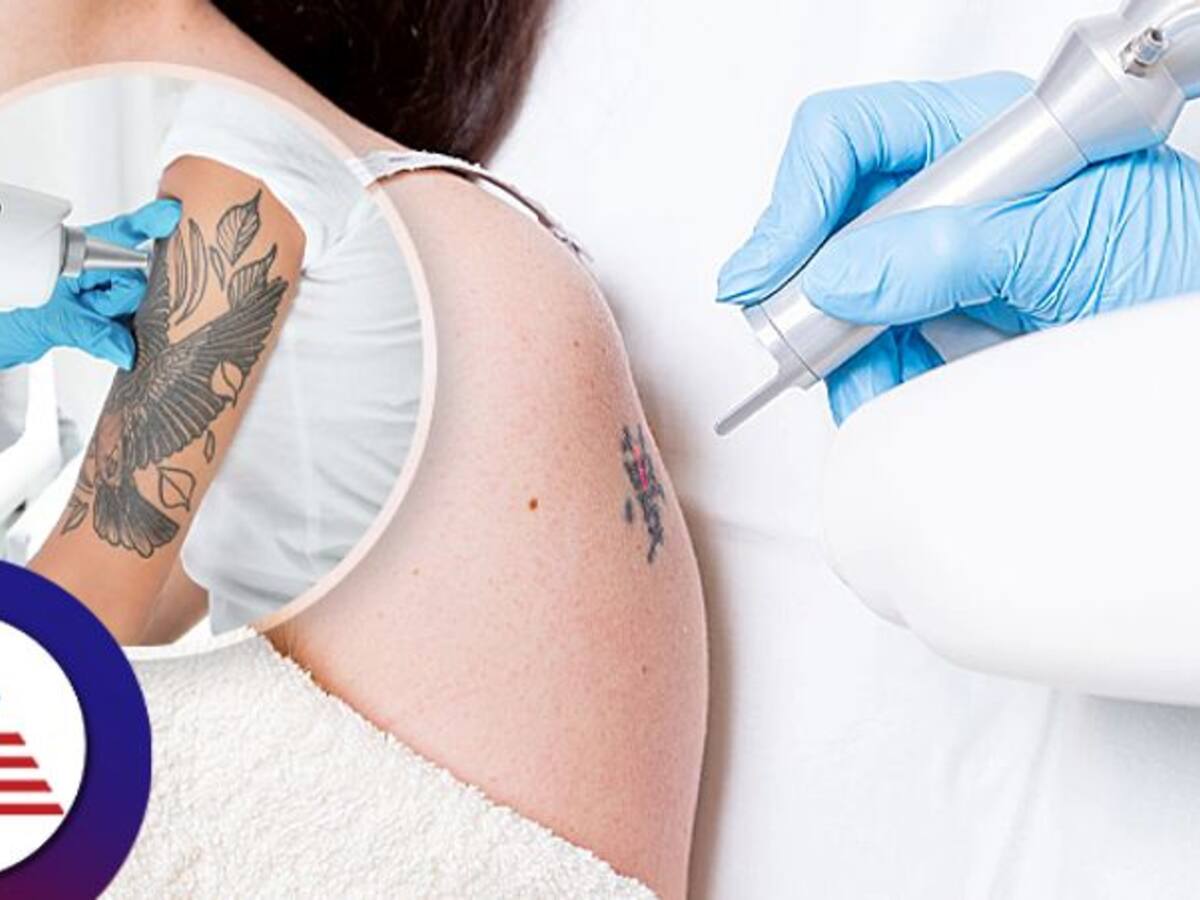 ISPUB.COM - Layered Dermabrasion: A Simple Controlled Method For The  Treatment Of Tattoos