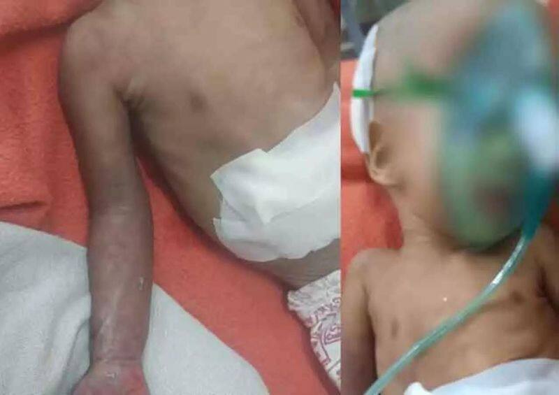 The Tamil Nadu government has ordered an inquiry into the amputation of a child hand due to improper treatment in Chennai