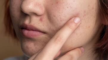 here is a healthy drink to treat acne at home hyp here is a healthy drink to treat acne at home hyp