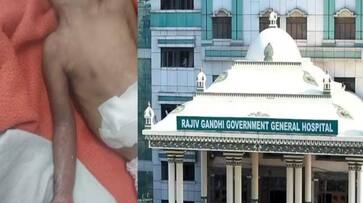Investigation report released on Infant hand removal issue in rajiv gandhi govt hospital Investigation report released on Infant hand removal issue in rajiv gandhi govt hospital