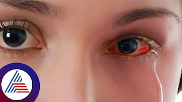 Madras eye infection that spreads easily.. How to protect yourself? Rya Madras eye infection that spreads easily.. How to protect yourself? Rya