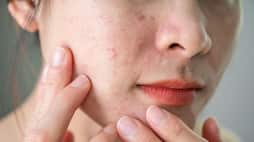 Best Home Remedies for Acne Problem ram 