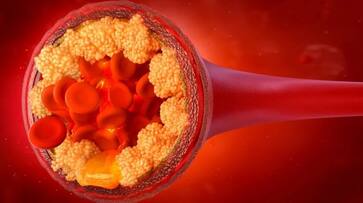 tips to prevent high cholesterol naturally-rse- tips to prevent high cholesterol naturally-rse-